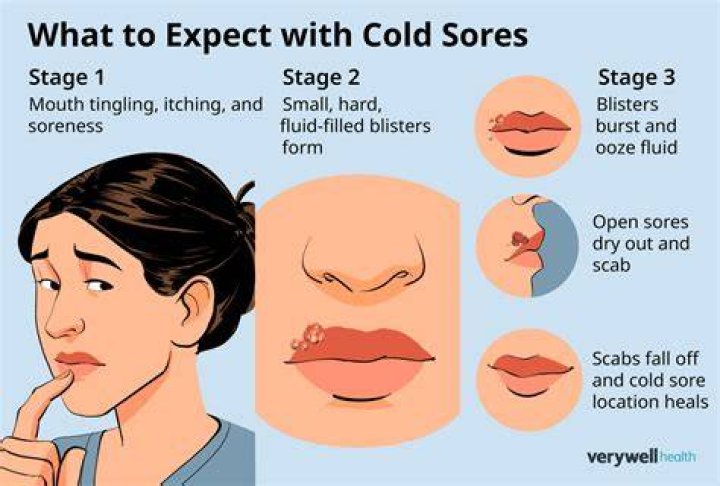 Can You Pop Cold Sores? Exploring Myths, Facts, and Effective Treatments