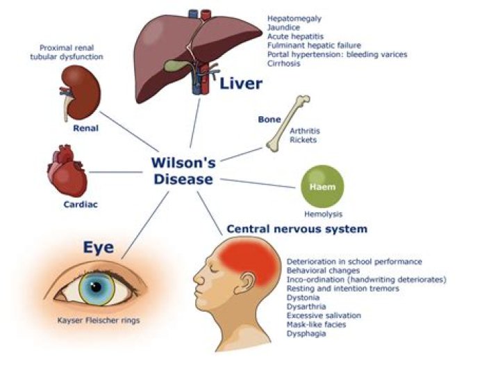 Wilson Disease Mnemonic: A Comprehensive Guide to Understanding and Managing the Condition
